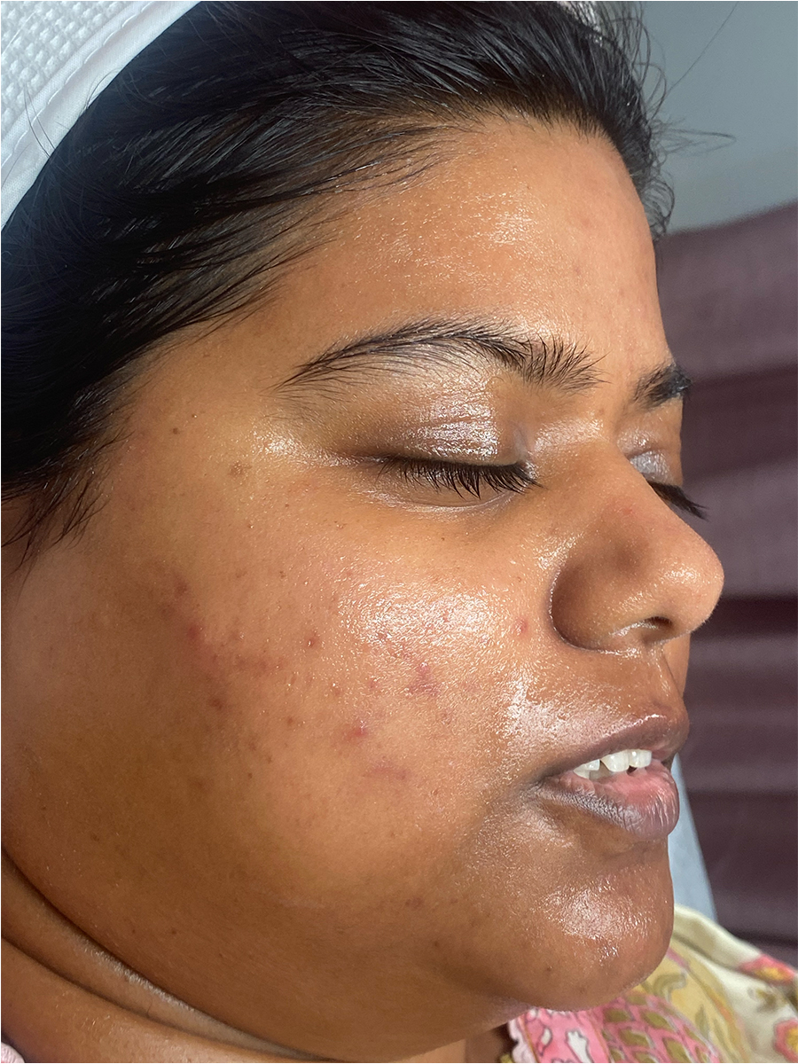 After treatment