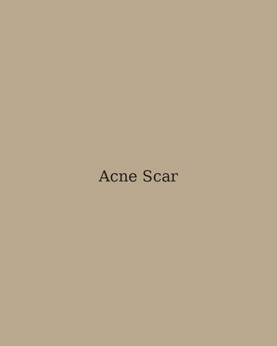 Acne Scar Treatment